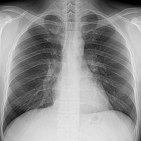 Normal Pa Chest X Ray Inspiration Till Th Posterior Rib Hot Sex Picture